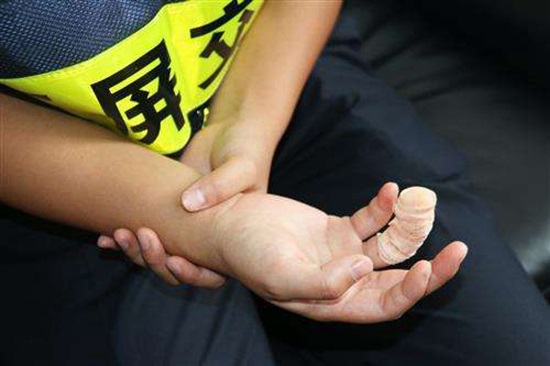 男子餐廳就餐誤把屏風(fēng)當墻扶 右手食指被夾斷